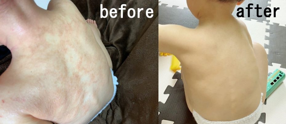 ステロイドをリバウンドなしでやめるには Abcビスケット大好きくん 一歳半 中症アトピー 子育て支援ブログ 漫画 らくらく子育て研究所 ステロイドをリバウンドなしでやめるには Abcビスケット大好きくん 一歳半 中症アトピー 子育て支援ブログ 漫画 らくらく子育て研究所